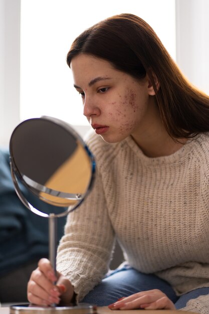 Effective Ways to Avoid and Heal Acne Scars